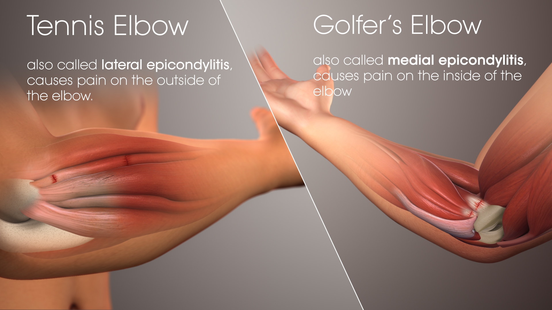 Tennis elbow